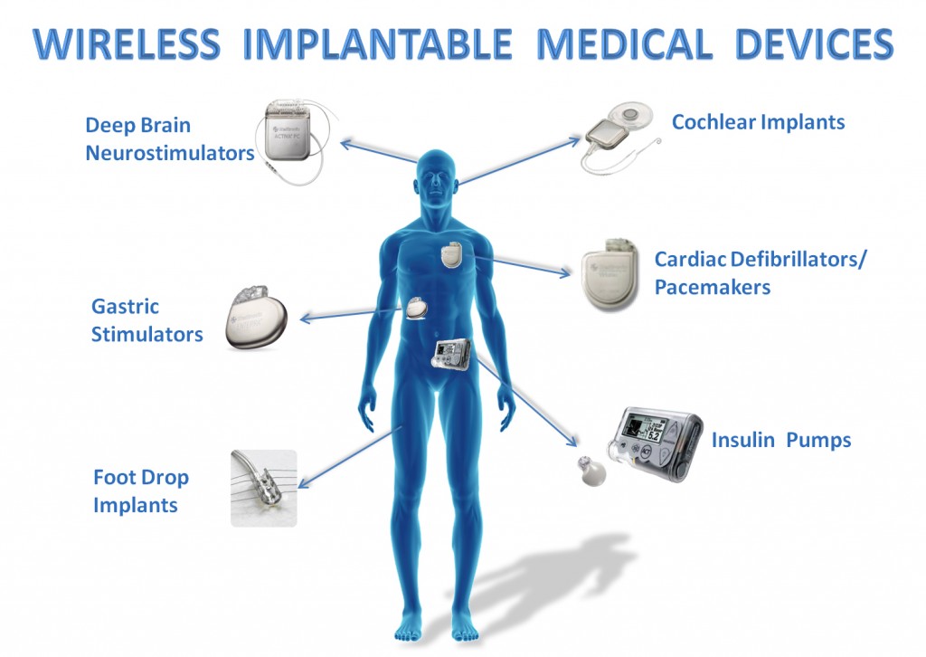 Implants to assist you with body functions Innovation Essence