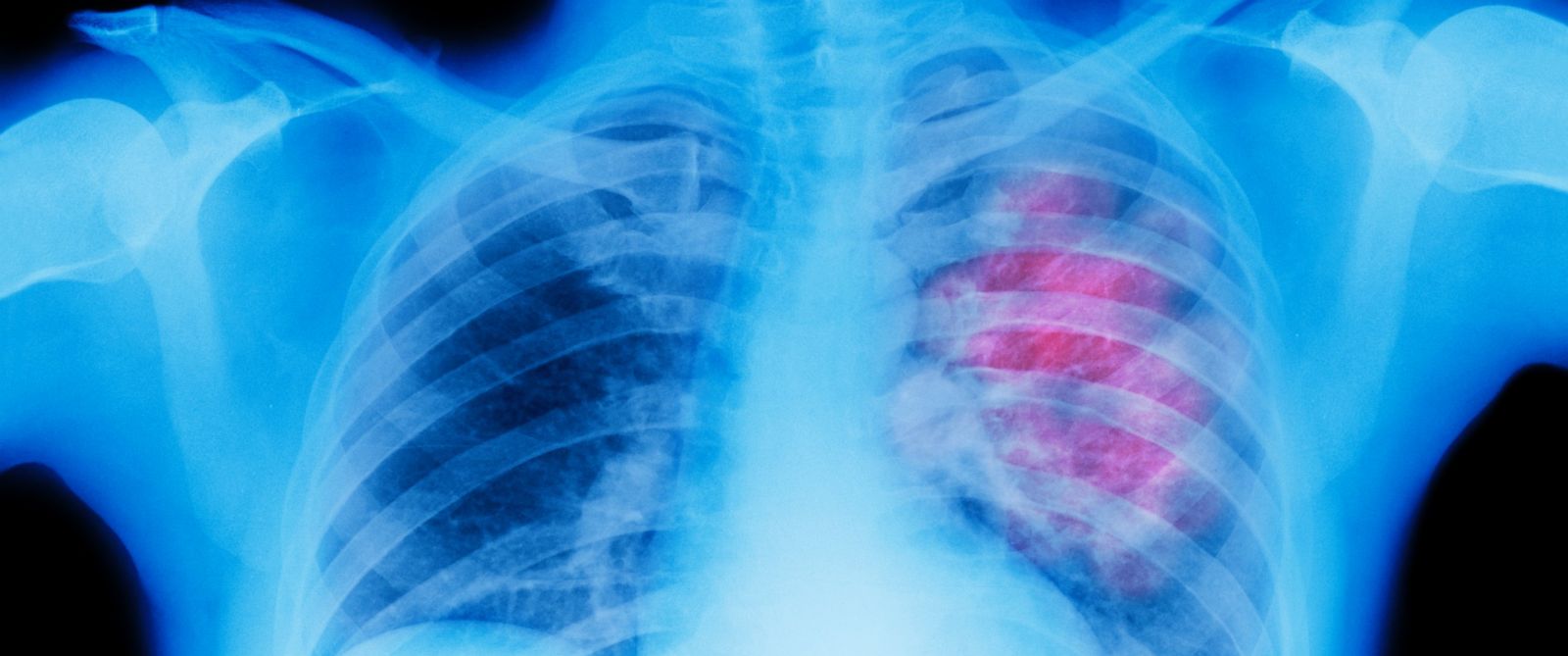 Simple test identifies lung cancer patients with best