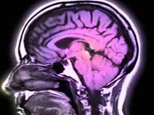 parkinson1