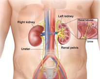 cancer kidney