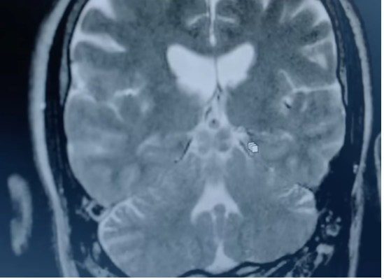 PRIMA BCI Implant Restores Functional Central Vision to Patients with Geographic Atrophy Caused By Age-Related Macular Degeneration